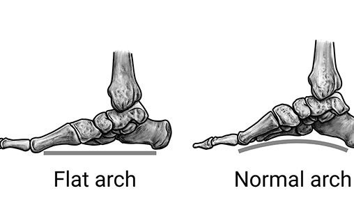 Arches